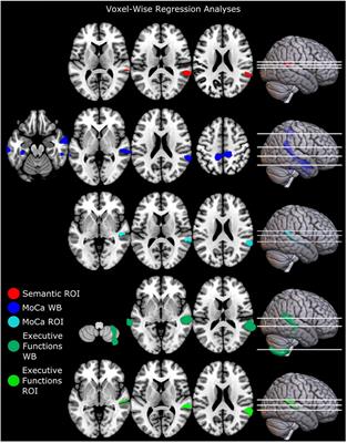 Characterization of Mild and Moderate Dysarthria in Parkinson’s Disease: Behavioral Measures and Neural Correlates